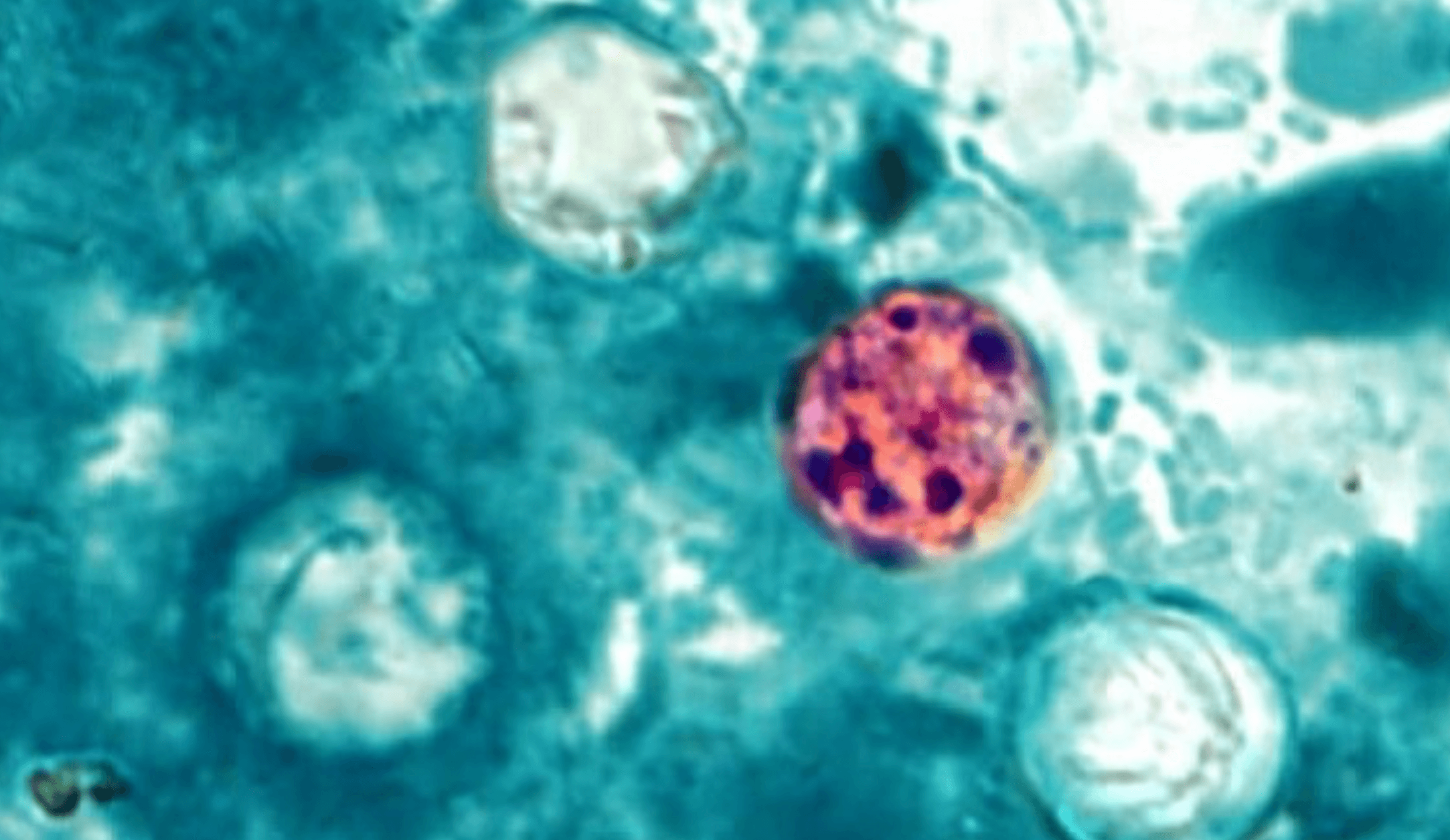 Patient count in parasitic outbreak continues to increase